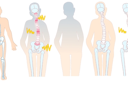 体の歪み、骨の歪み